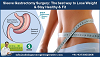 Sleeve Gastrectomy surgery: The best way to Lose Weight & Stay Healthy & Fit 