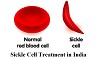 Sickle Cell Anemia Treatment Cost India